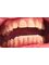 Vedra Dental 24/7 Holistic Clinic - Before 4 upper front Veneers 