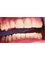 Vedra Dental 24/7 Holistic Clinic - Try-in 4 upper front Veneers 