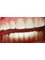 Vedra Dental 24/7 Holistic Clinic - 4 Veneers + 3weeks 