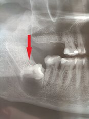 Wisdom Tooth Extraction - Dental Center Dr.Boneva