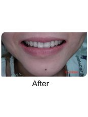 Dental Crowns - International Dental Clinic