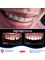 Pka Chhouk Dental Clinic - Crown Zirconium 