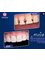 Pka Chhouk Dental Clinic - Filling teeth  