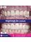 Pka Chhouk Dental Clinic - Crown Zirconium 