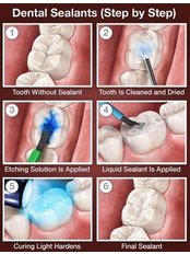Dental Sealant - MYRDH Dental Hygiene Spa