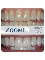 Zoom! Teeth Whitening - SunnyView Dental Georgetown