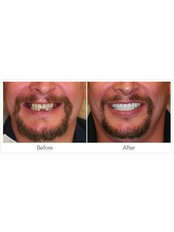 Dental Implants - SunnyView Dental Georgetown
