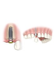 Dental Implants - Atlantis Dental - Guelph