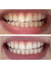 Teeth Whitening - MEK Dental