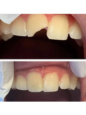 Chipped Tooth Repair - MEK Dental