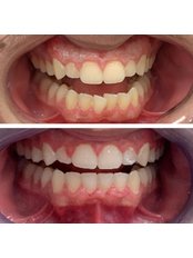 Clear Teeth Aligners - MEK Dental