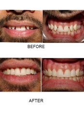 Invisalign™ - Dr. Bobby Brown and Associates