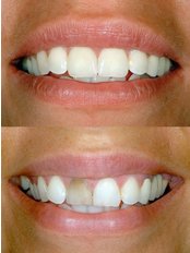 CEREC Crowns in just 1 hour! - Great Lakes Dental