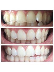 Teeth Whitening - First Impressions Dental Services