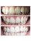 First Impressions Dental Services - before, after one session, and final result 