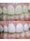 First Impressions Dental Services - before/after 