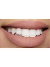 Whitening Top Up Treatment - First Impressions Dental Services