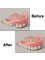Denture clinic - Denture Repair 