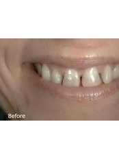 Dental Bonding - Little River Dental