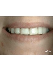Dental Bonding - Little River Dental