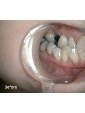 Instant Orthodontics - Little River Dental