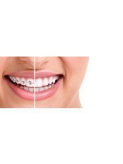 Adult Braces - DentisteALaval.com