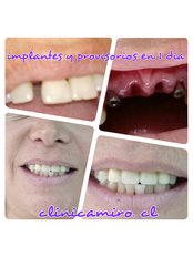 dental inmediate loading implants - Clinica Miró
