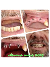 dental implant treatment, before and after - Clinica Miró