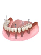 Dental Implants - VIP Dental Clinics