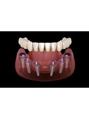 All-on-6 Dental Implants - VIP Dental Clinics