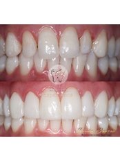 Composite Veneers - Dental Experience