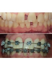 Orthodontics - SOLUCIÓN ORAL
