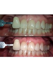 Teeth Whitening - SOLUCIÓN ORAL