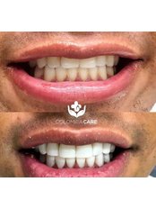 Composite Veneers - Colombia Care Dental