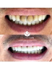 Veneers - Colombia Care Dental