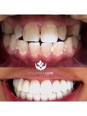 Porcelain Veneers - Colombia Care Dental