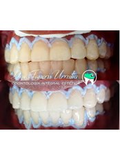 Teeth Whitening - Dra. Faneris Urrutia