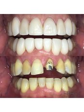 Dental Crowns - Fross Clinic
