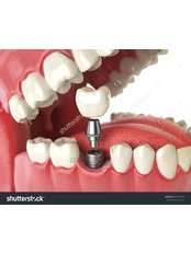 Dental Implants - Clear Choice