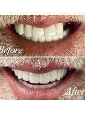 Full Mouth Rehabilitation - Costa Rica Dental Design