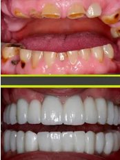 All-on-4 Dental Implants - Costa Rica Dental Design
