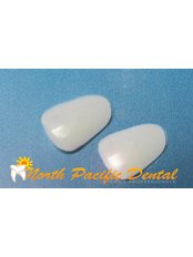 Veneers - North Pacific Dental