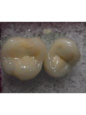 Dental Crowns - North Pacific Dental