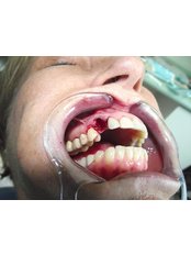 Immediate Implant Placement - North Pacific Dental