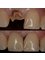 Galeria Dental - Oral Hospital - single implant 