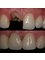 Galeria Dental - Oral Hospital - single implant 