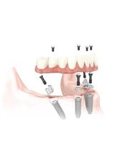 All-on-4 Dental Implants - Premier Dental Care Center