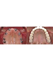 Full mouth rehabilitation - Premier Dental Care Center