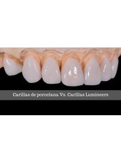 Lumineers™ - Clínica Dental O.C.I Liberia
