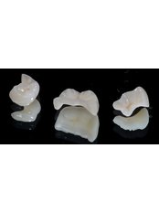 Porcelain Inlay or Onlay - Clínica Dental O.C.I Liberia